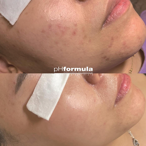 Case Study - PROTONPEN microneedle resurfacing - 2