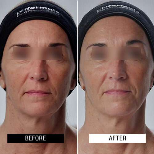 Case Study - PROTONPEN nanoneedle resurfacing - 1