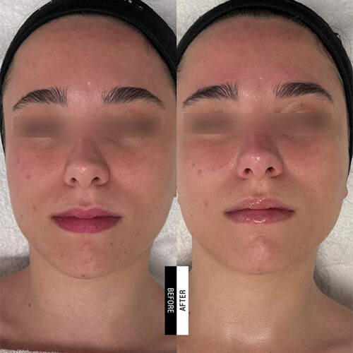 Case Study - PROTONPEN nanoneedle resurfacing - 2