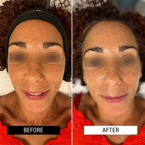 Case Study - PROTONPEN nanoneedle resurfacing - 3