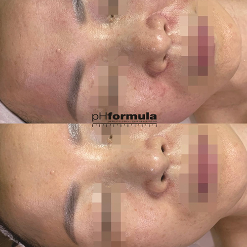 Case Study - Radiance boost treatment - 1