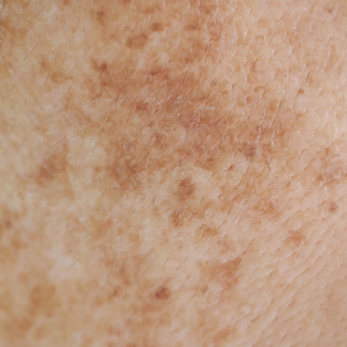 Understanding Hyperpigmentation Phformula Africa