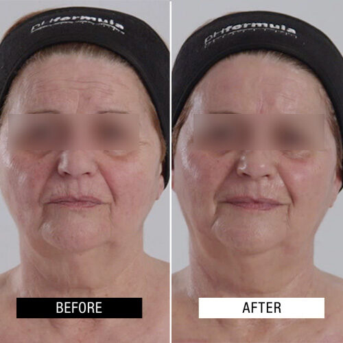 Case Study - PROTONPEN microneedle resurfacing - 1